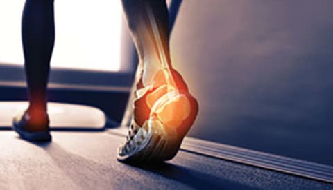 Plantar Fasciitis